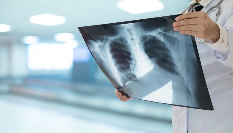 Nova proposta para políticas públicas em hipertensão pulmonar