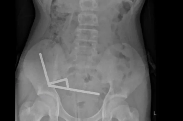 raio-x-imas-em-intestino.webp